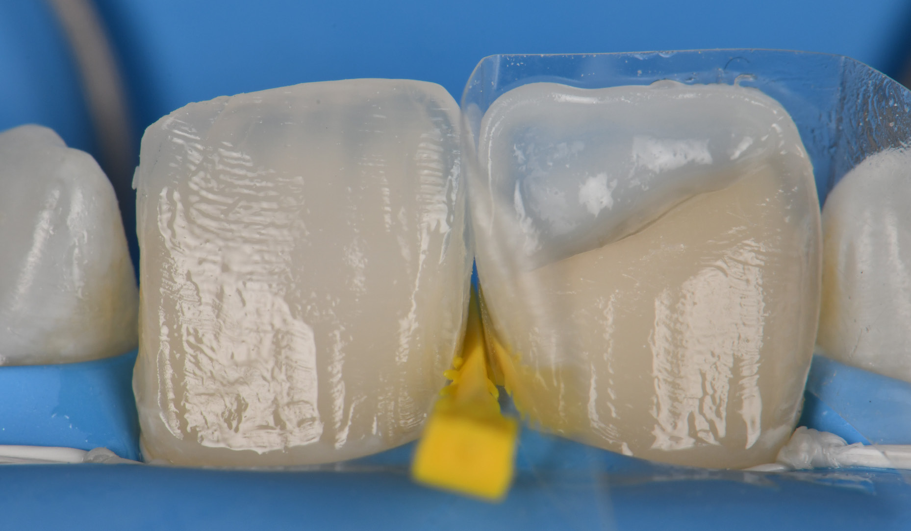 Figure 2: Pre-crimped Mylar matrix repeated on the DIBP aspect of tooth 2.1 to close the available space. CLEARFIL MAJESTY&trade; ES-2 Universal UL is used here.